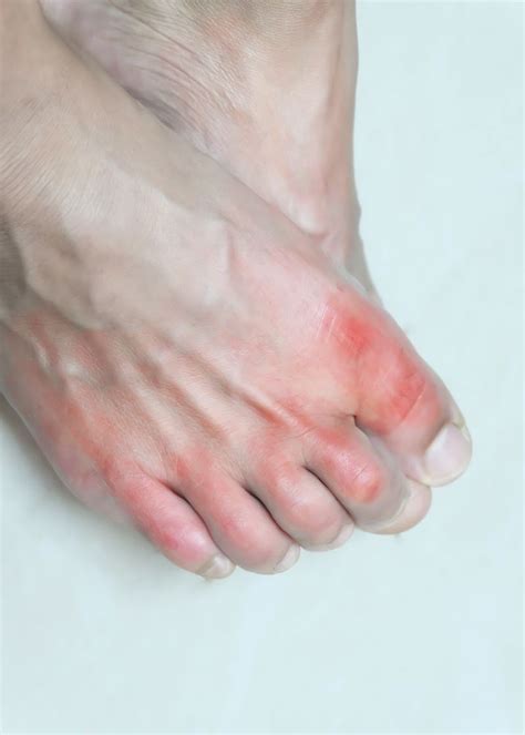 Treating Gout with Massage | Moyer Total Wellness