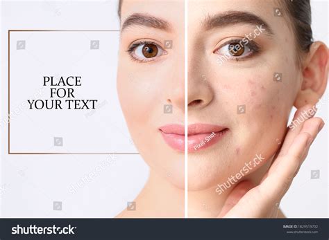 Young Woman Before After Acne Treatment Stock Photo 1829519702 ...