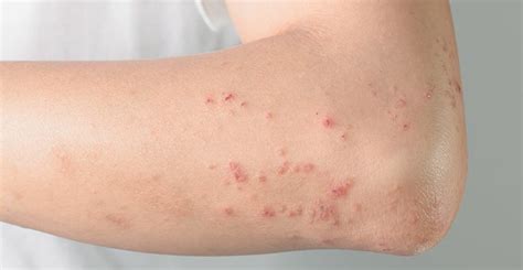 Impetigo Treatment Specialists in Coral Springs, FL