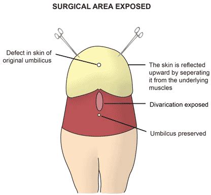 Divarication - Melbourne Hernia Clinic