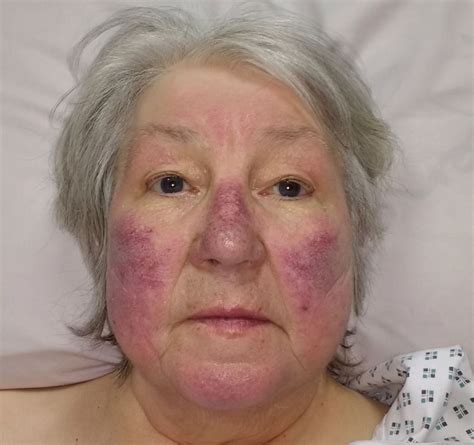 Malar rash with pulmonary hypertension and chronic obstructive pulmonary disease | BMJ Case Reports