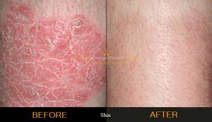 Psoriasis Treatment (£195) | London Dermatology Clinic