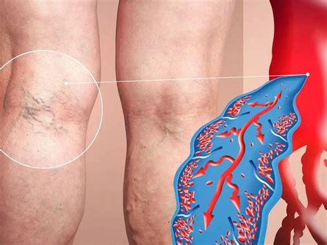 Blood Clot In Leg Symptoms | Deep Vein Thrombosis(DVT): Signs of blood ...