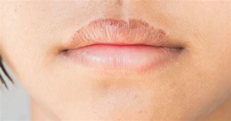 Six ways to treat chapped lips - Say Tik