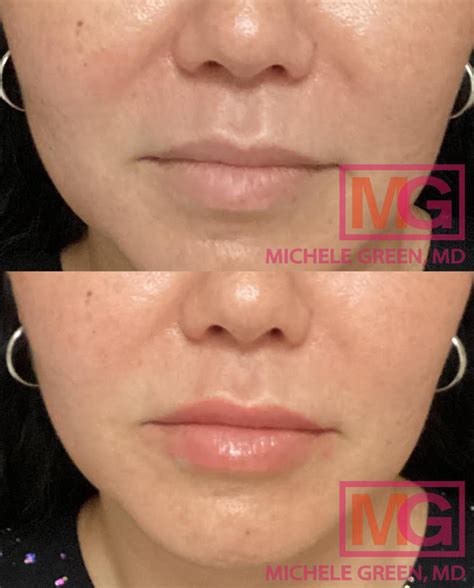 Vertical Lip Lines, Best Fillers & How To Reduce Vertical Lip Lines