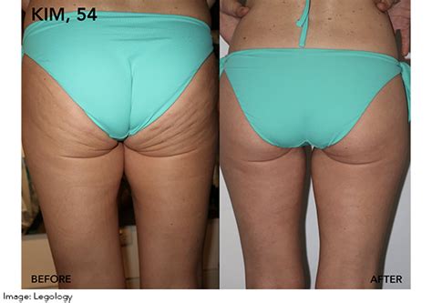 Cellulite Cupping Before And After Photos That Will Make, 55% OFF