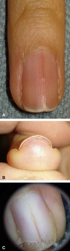 Longitudinal erythronychia: Suggestions for evaluation and management ...