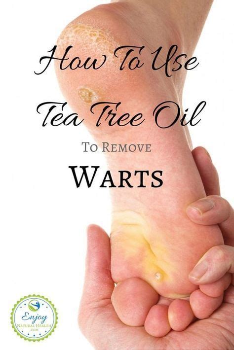 Get Rid Of Stubborn Warts With Tea Tree Oil! | Tea tree oil benefits ...