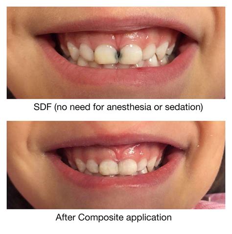 SDF: Cavity treatment with no injections