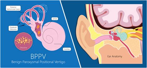 Vestibular Rehabilitation for Vertigo - Capstone Physical Therapy