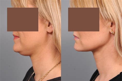 Neck Liposuction / Chin Liposuction Before and After Photo Gallery | New York, NY | Thomas P ...