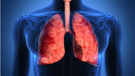 Fibrosis pulmonar: causas, síntomas y tratamiento