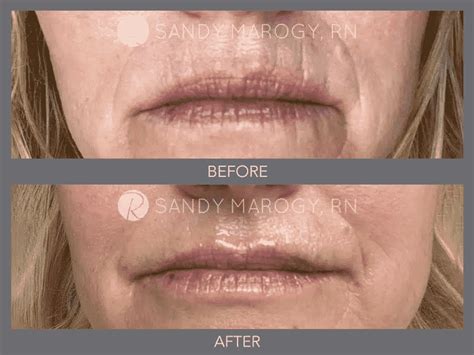 Experiencing deep lines around your mouth? - Revitalize Plastic Surgery