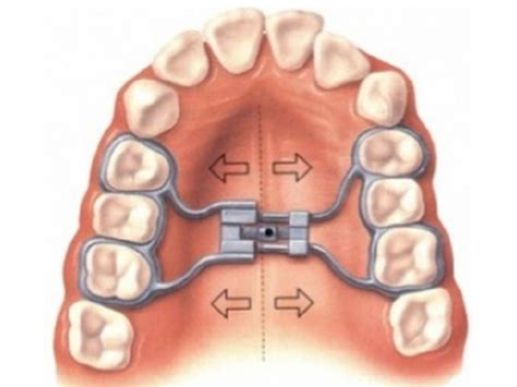 TANATAREC Orthodontics • Skeletal Expander (Hyrax)