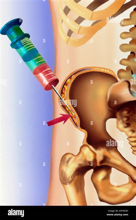 BONE MARROW ASPIRATION Stock Photo - Alamy