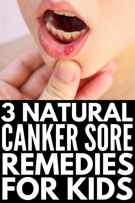 Natural and Effective: 9 Canker Sore Remedies That Work Fast | Canker ...