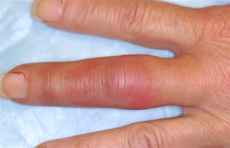 What Is Causing This Woman’s Swollen, Red, and Tingling Finger ...