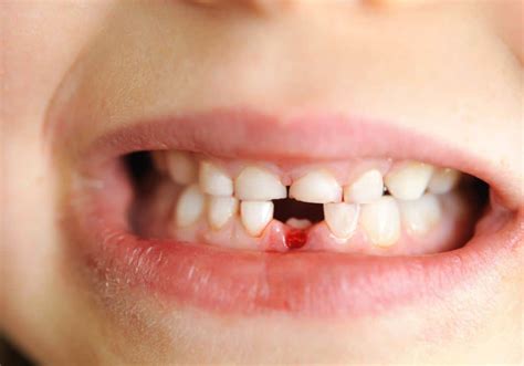 Dream About Teeth Falling Out With Blood? (6 Spiritual Meanings)