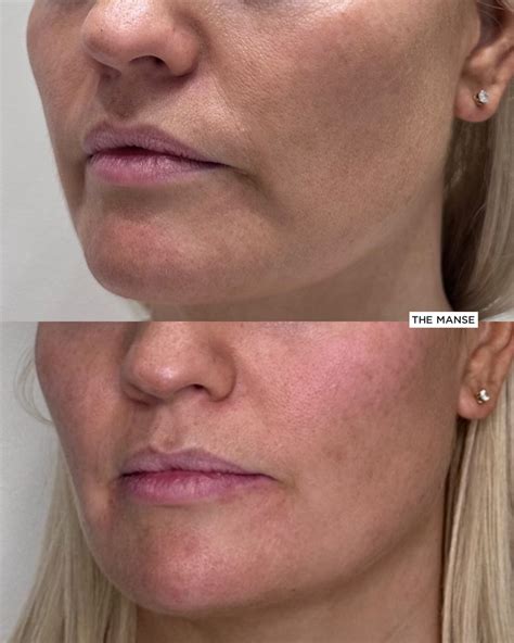 Marionette Filler Before and After - Best Clinic Sydney for Dermal Fillers