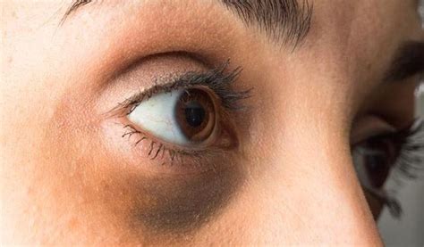 Say bye bye to dark circles under your eyes with these remedies - OrissaPOST