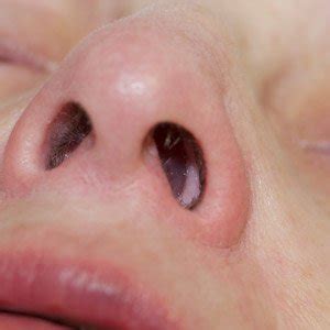 Cancer Nasal Polyps Vs Normal - Nasal polyps | SMARTY PANCE : The nasal turbinates are ...