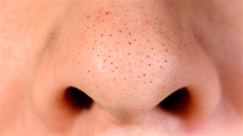 Here's What You Need To Know Before Removing Blackheads