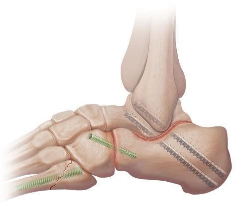 Arthrex - Subtalar Arthrodesis