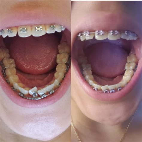 5 hour difference on my bottom right (pictured left) incisor! : r/braces