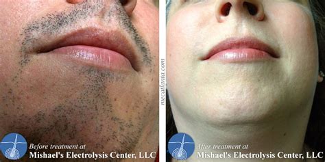 Before & After Electrolysis Hair Removal | Mishael's Electrolysis Center