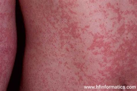 Maculopapular Rash: Pictures Symptoms, Causes, and Treatment