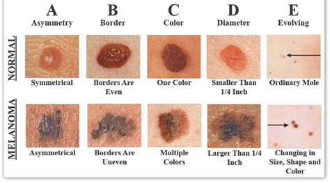 Malignant Melanoma — MC Medical Group