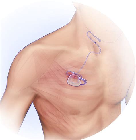 It’s sweet dreams for sleep apnea patient with this implanted device