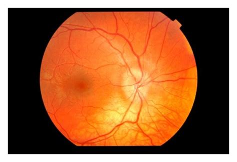 ((a), (b)) Bilateral optic disc edema on initial examination. There is ...