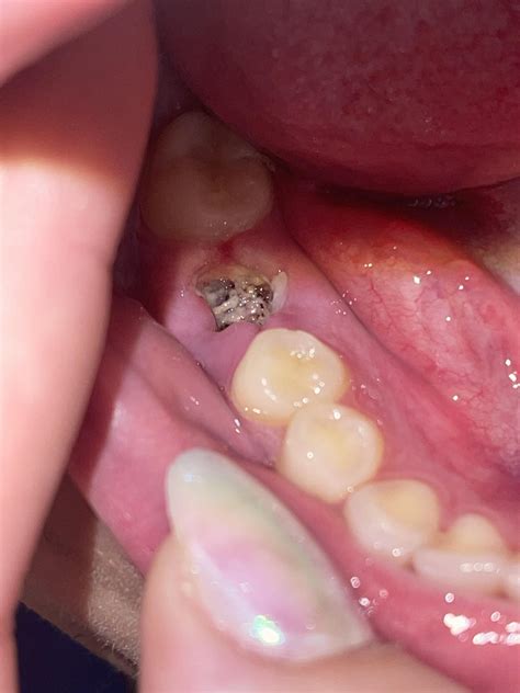 Infection? Dry Socket? Normal Healing? : r/DentalDudes