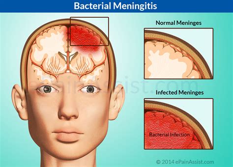 Meningite A Inflama O Das Meninges Meningitis Bacterial | Hot Sex Picture