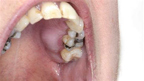 Kid With Abscess On Gum : Dental Abscess In A Child Stock Image C008 3595 Science Photo Library ...