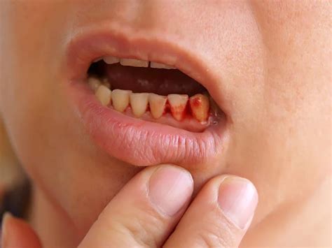 What Are the Causes and Symptoms of Blood Blister in Mouth?