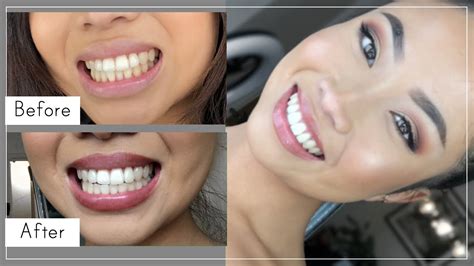 diy whitening strips for teeth - Karma Tuck