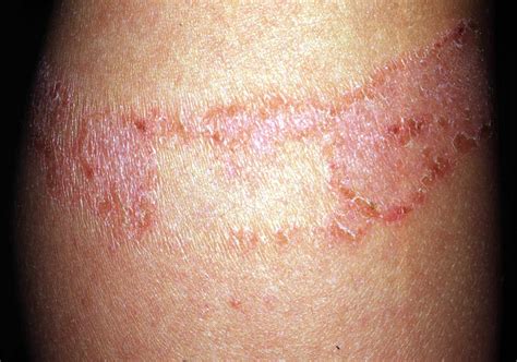 16 Different Kinds of Skin Rashes: Pictures and More