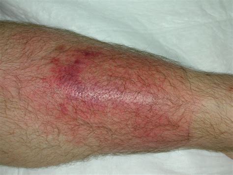 Cellulitis Infection A Bacterial Skin Infection - vrogue.co