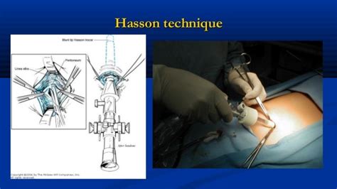 Laparoscopic surgery. Intro. History of Armata manus laparoscopic sim…