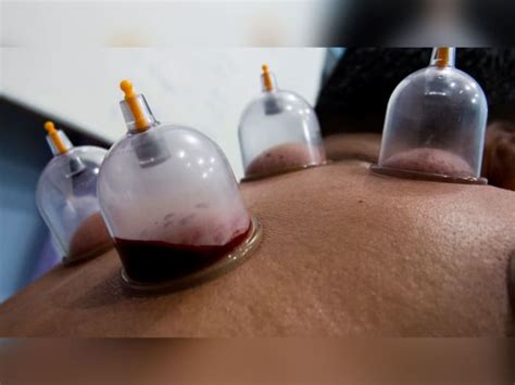 Everything Fit Guys Need to Know About Wet Cupping - Men's Fitness