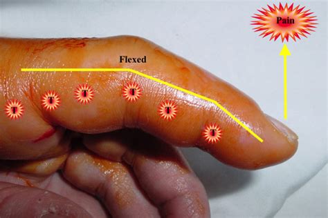 Kanavel's Sign | Hand Surgery Resource