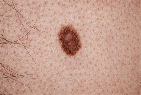 Picture of Compound Nevus Picture Image on RxList.com