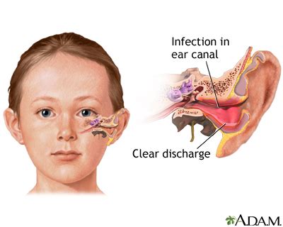 Ear Infection From Swimming