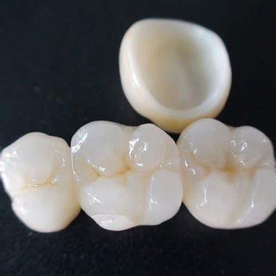 Best Zirconia Crown In Islamabad, Rawalpindi & Pakistan | Cost