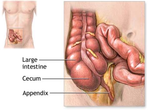 Appendix Pain - Location, Symptoms, Treatment and Surgery | HubPages