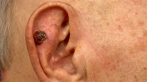 Ear Cancer: Types, Symptoms, Causes, Treatments, and More
