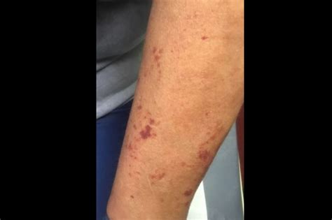 Derm Dx: Dark Spots on the Arms - Clinical Advisor