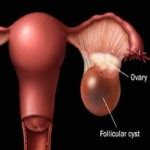 Best Herbal Remedies For Ovarian Cysts - How To Treat Ovarian Cysts ...